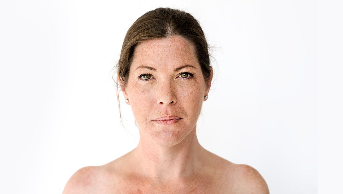 Azelaic Acid for Melasma – How It Works, What to Expect, and Best Products to Use