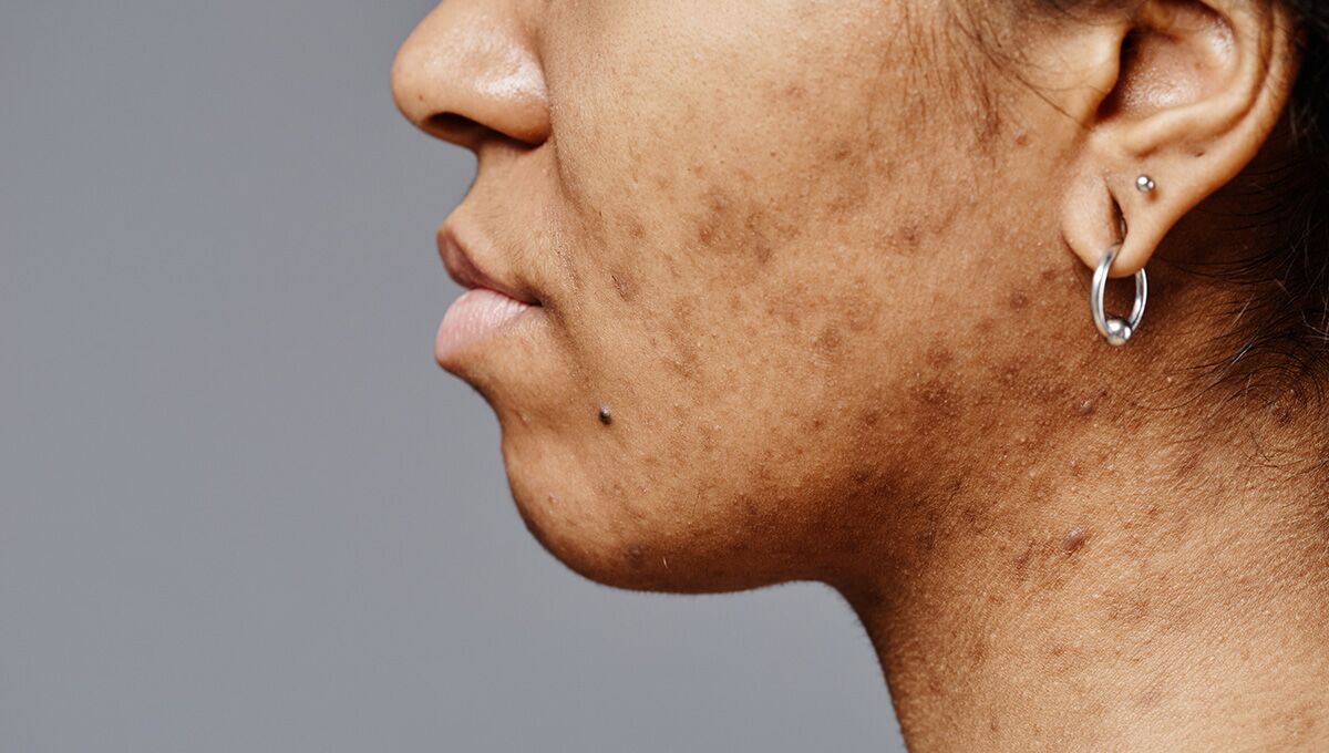 How to Treat Hyperpigmentation on Black Skin Effectively