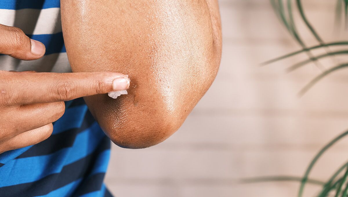 Why Are My Elbows Dark? Causes & Skincare Solutions