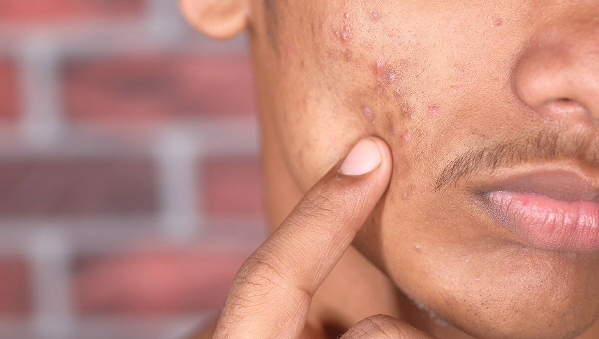 Acne Scars vs Hyperpigmentation – How to Tell the Difference & What Really Works