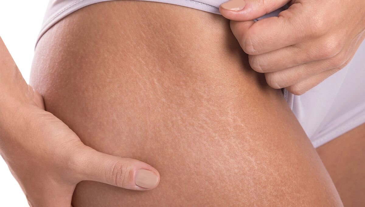 Does Bio Oil Work for Stretch Marks What to Expect & the Best Bio Oil Products You Can Try