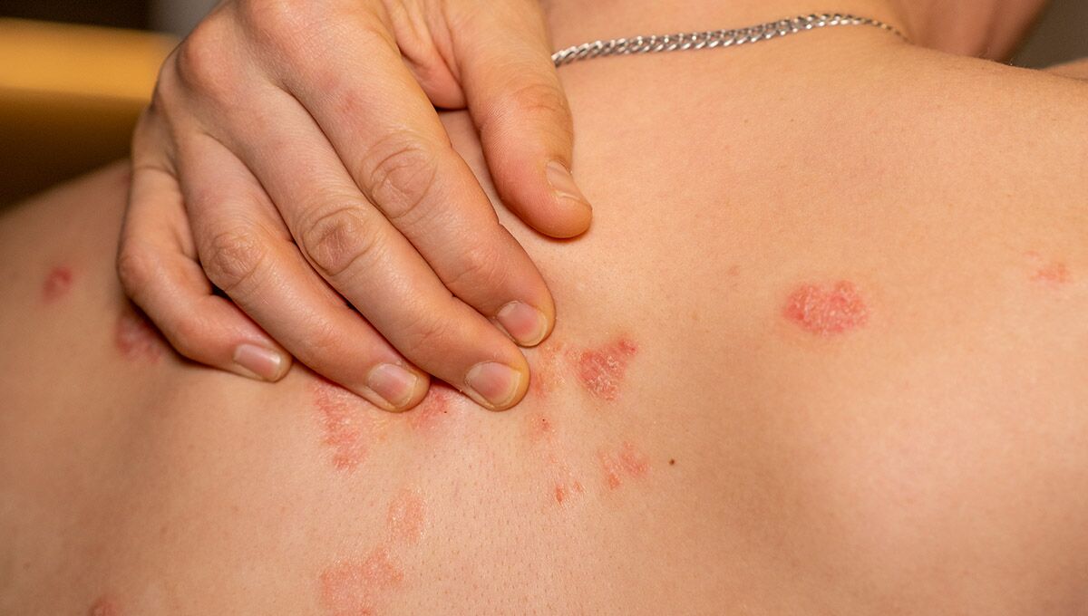 How to Choose the Right Body Wash for Psoriasis Relief and Skin Comfort