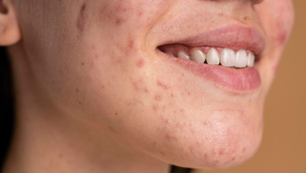 Is Niacinamide Good for Rosacea What You Need to Know Before Trying It